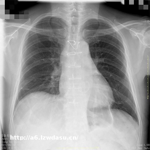 【病例分享】肥厚型心肌病术后心脏康复